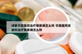 成都華西醫(yī)院治療銀屑病怎么樣 華西醫(yī)院皮膚科治療銀屑病怎么樣