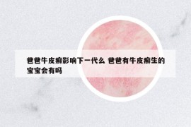 爸爸牛皮癬影響下一代么 爸爸有牛皮癬生的寶寶會有嗎