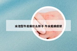 水泡型牛皮癬什么樣子 牛水皰病癥狀