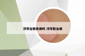 浮萍治銀屑病嗎 浮萍散治病