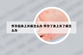 懷孕后身上長癬怎么辦 懷孕了身上長了癬怎么辦