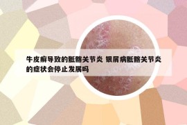 牛皮癬導致的骶髂關(guān)節(jié)炎 銀屑病骶髂關(guān)節(jié)炎的癥狀會停止發(fā)展嗎