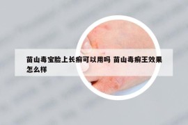 苗山毒寶臉上長(zhǎng)癬可以用嗎 苗山毒癬王效果怎么樣