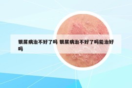 銀屑病治不好了嗎 銀屑病治不好了嗎能治好嗎