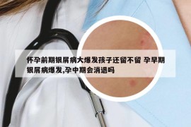 懷孕前期銀屑病大爆發(fā)孩子還留不留 孕早期銀屑病爆發(fā),孕中期會消退嗎