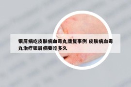 銀屑病吃皮膚病血毒丸康復(fù)事例 皮膚病血毒丸治療銀屑病要吃多久