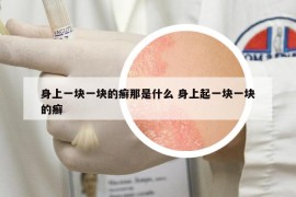 身上一塊一塊的癬那是什么 身上起一塊一塊的癬