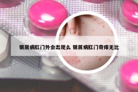銀屑病肛門外會出現(xiàn)么 銀屑病肛門奇癢無比