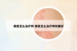 銀屑怎么治療啊 銀屑怎么治療啊效果好