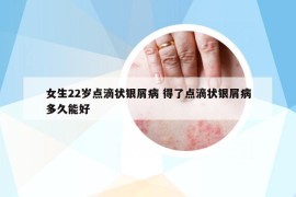女生22歲點(diǎn)滴狀銀屑病 得了點(diǎn)滴狀銀屑病多久能好