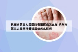 杭州市第三人民醫(yī)院看銀屑病怎么樣 杭州市第三人民醫(yī)院看銀屑病怎么樣啊