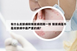 有什么皮膚病和銀屑病初期一樣 銀屑病是不是皮膚病中最嚴(yán)重的病?