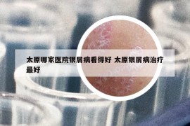 太原哪家醫(yī)院銀屑病看得好 太原銀屑病治療最好