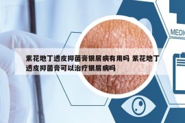 紫花地丁透皮抑菌膏銀屑病有用嗎 紫花地丁透皮抑菌膏可以治療銀屑病嗎