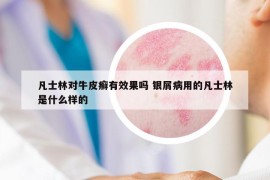 凡士林對牛皮癬有效果嗎 銀屑病用的凡士林是什么樣的