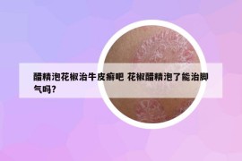 醋精泡花椒治牛皮癬吧 花椒醋精泡了能治腳氣嗎?