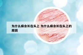 為什么癬會長在頭上 為什么癬會長在頭上的原因