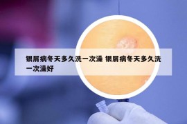 銀屑病冬天多久洗一次澡 銀屑病冬天多久洗一次澡好