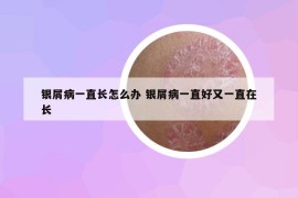 銀屑病一直長(zhǎng)怎么辦 銀屑病一直好又一直在長(zhǎng)