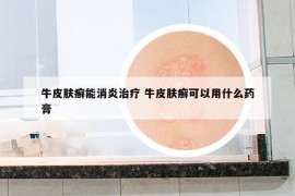牛皮膚癬能消炎治療 牛皮膚癬可以用什么藥膏