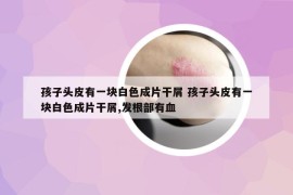 孩子頭皮有一塊白色成片干屑 孩子頭皮有一塊白色成片干屑,發(fā)根部有血