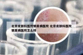 北京皮膚科醫(yī)院銀屑病醫(yī)院 北京皮膚科醫(yī)院銀屑病醫(yī)院怎么樣