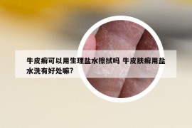 牛皮癬可以用生理鹽水擦拭嗎 牛皮膚癬用鹽水洗有好處嘛?
