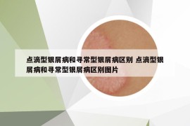 點(diǎn)滴型銀屑病和尋常型銀屑病區(qū)別 點(diǎn)滴型銀屑病和尋常型銀屑病區(qū)別圖片