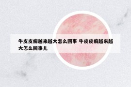 牛皮皮癬越來越大怎么回事 牛皮皮癬越來越大怎么回事兒