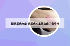 副銀屑病水痘 銀屑病如果得水痘了會咋樣
