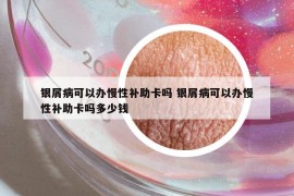銀屑病可以辦慢性補(bǔ)助卡嗎 銀屑病可以辦慢性補(bǔ)助卡嗎多少錢