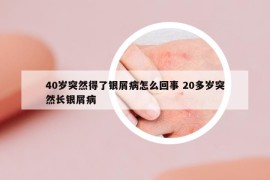 40歲突然得了銀屑病怎么回事 20多歲突然長(zhǎng)銀屑病
