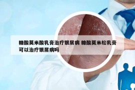 糠酸莫米酸乳膏治療銀屑病 糠酸莫米松乳膏可以治療銀屑病嗎