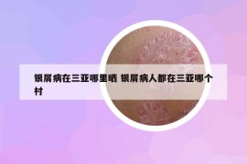 銀屑病在三亞哪里曬 銀屑病人都在三亞哪個村