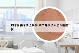 四個月孩子頭上長癬 四個月孩子頭上長癬圖片