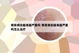 銀屑病會(huì)越來越嚴(yán)重嗎 銀屑病會(huì)越來越嚴(yán)重嗎怎么治療