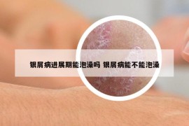 銀屑病進(jìn)展期能泡澡嗎 銀屑病能不能泡澡