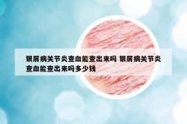 銀屑病關節(jié)炎查血能查出來嗎 銀屑病關節(jié)炎查血能查出來嗎多少錢