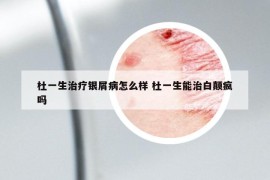 杜一生治療銀屑病怎么樣 杜一生能治白顛瘋嗎