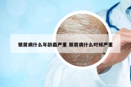 銀屑病什么年齡最嚴(yán)重 銀屑病什么時(shí)候嚴(yán)重