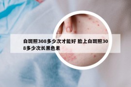 白斑照308多少次才能好 臉上白斑照308多少次長黑色素