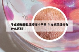 牛皮癬和慢性濕疹哪個嚴(yán)重 牛皮癬跟濕疹有什么區(qū)別