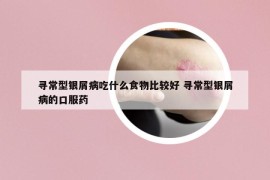 尋常型銀屑病吃什么食物比較好 尋常型銀屑病的口服藥