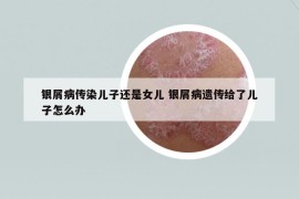 銀屑病傳染兒子還是女兒 銀屑病遺傳給了兒子怎么辦