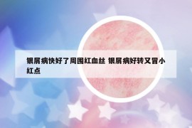 銀屑病快好了周圍紅血絲 銀屑病好轉(zhuǎn)又冒小紅點