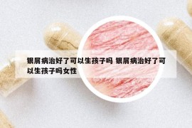 銀屑病治好了可以生孩子嗎 銀屑病治好了可以生孩子嗎女性