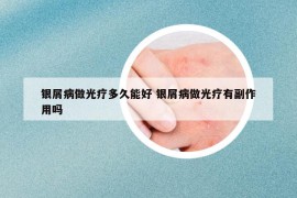 銀屑病做光療多久能好 銀屑病做光療有副作用嗎