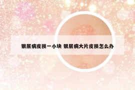 銀屑病皮損一小塊 銀屑病大片皮損怎么辦