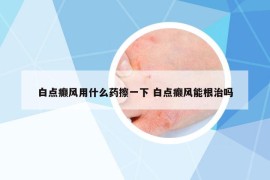 白點癲風用什么藥擦一下 白點癲風能根治嗎