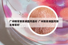 廣州哪家銀屑病醫(yī)院最好 廣州銀屑病醫(yī)院排名哪家好